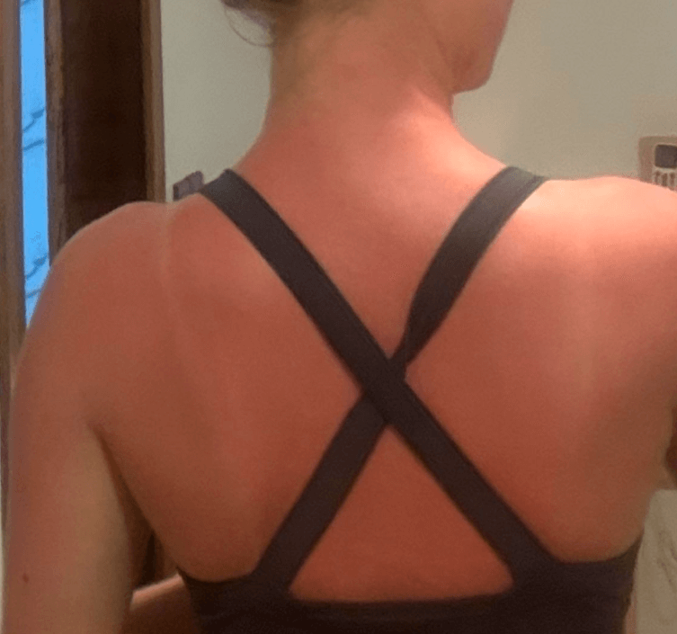 Sonnenbrand am Rücken nach starker Sonne in Ägypten trotz Sonnencreme